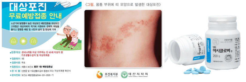 대상포진 예방접종, 대상포진, 아시클로버 사진