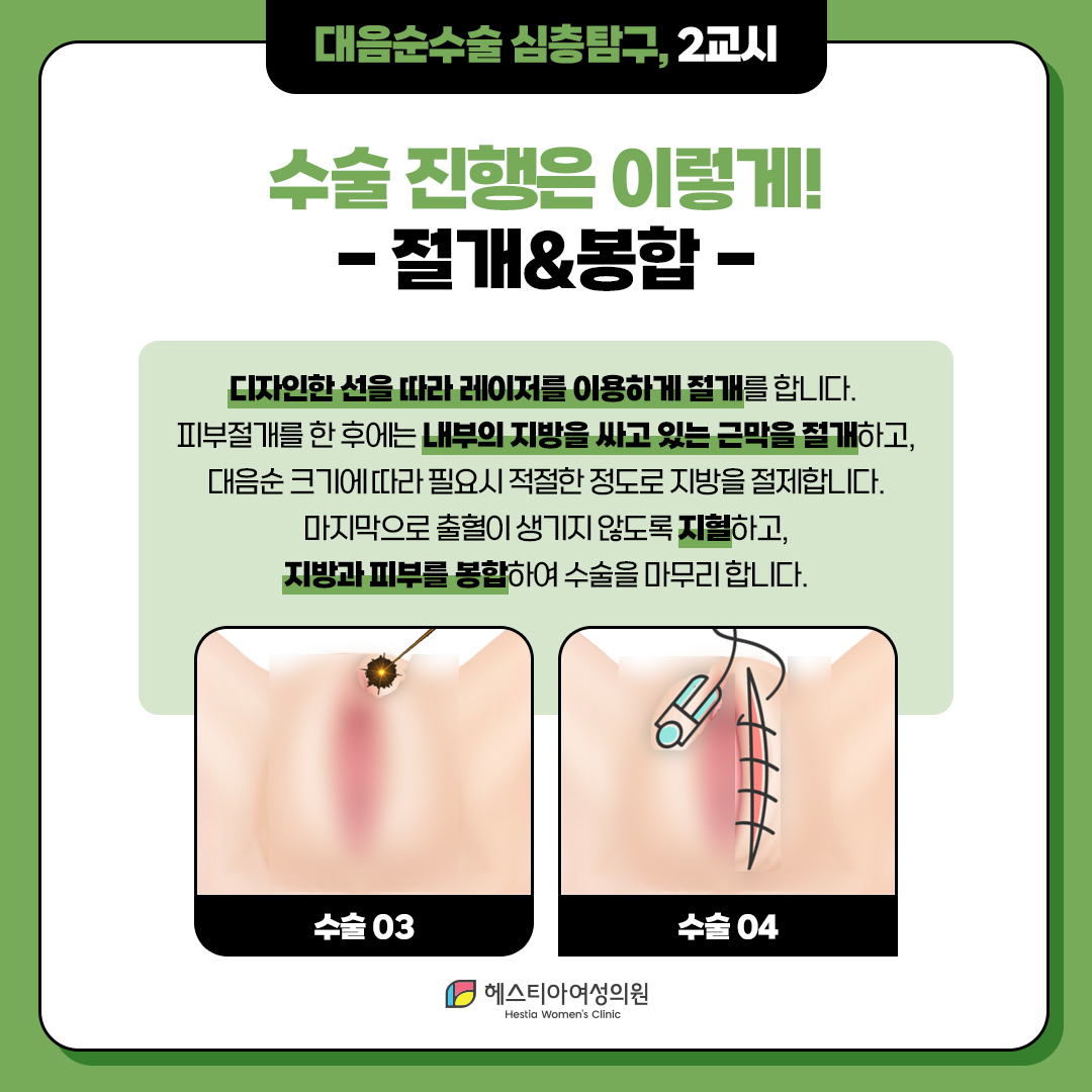 대음순수술 진행 절개&봉합