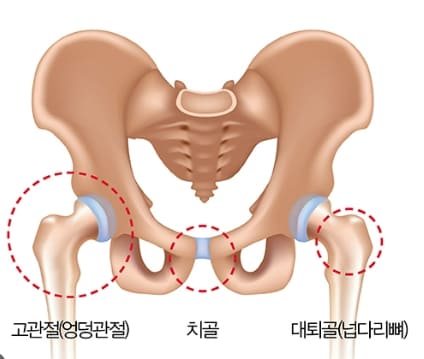 혹시 고관절(股關節,hip joint)을 아시나요?...골절 후 사망률 70%