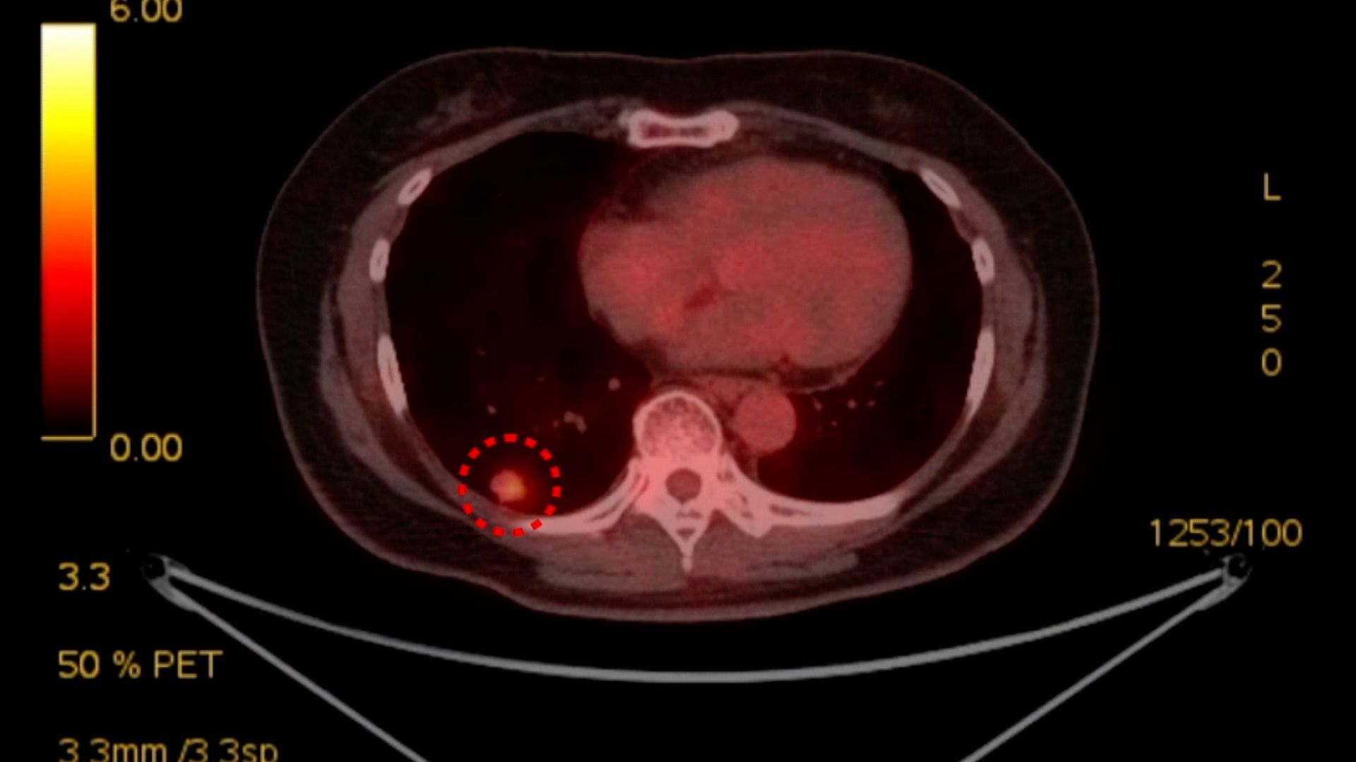 명의 폐암이 달라졌어요
