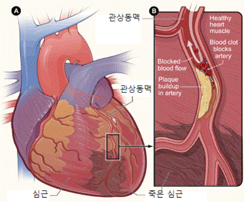 Percutaneous coronary intervention 경피적관상동맥중재술