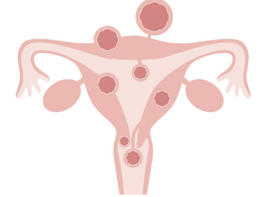 자궁근종 증상, 수술후 회복기간, 크기별 치료 총정리 (2024ver)