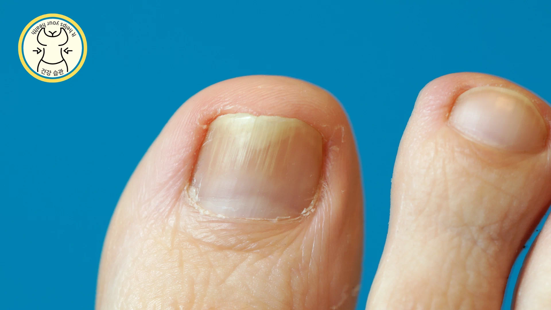 내성발톱은 무엇인가?