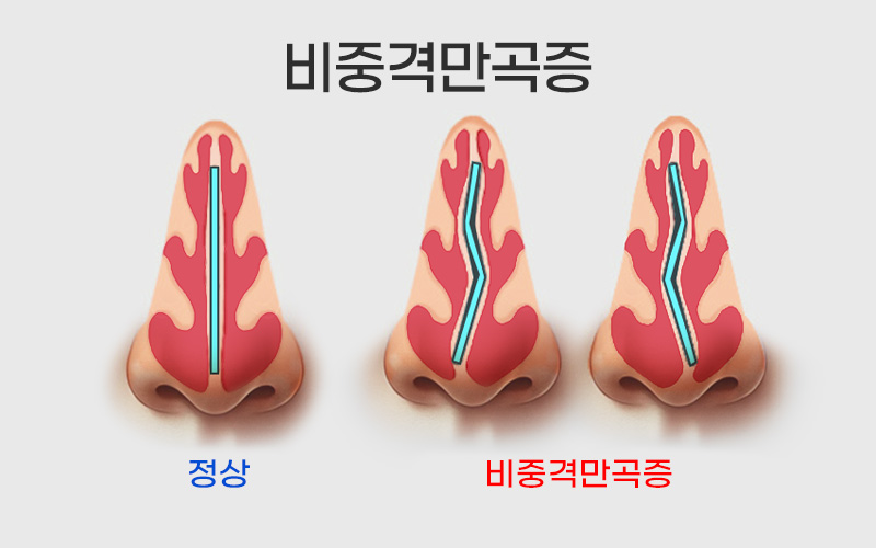 비중격 만곡증