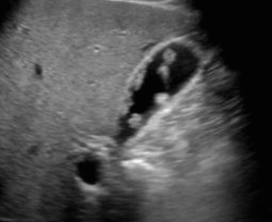 콜레스테롤 용종 (cholesterol polyp)