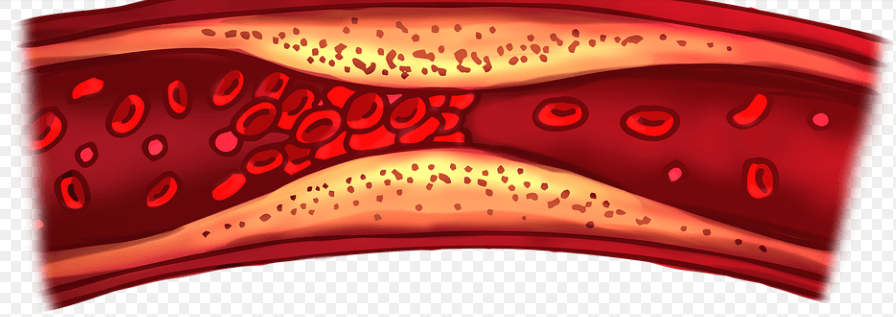 고지혈증에 나쁜 음식으로 혈관에 문제가 생긴 모습