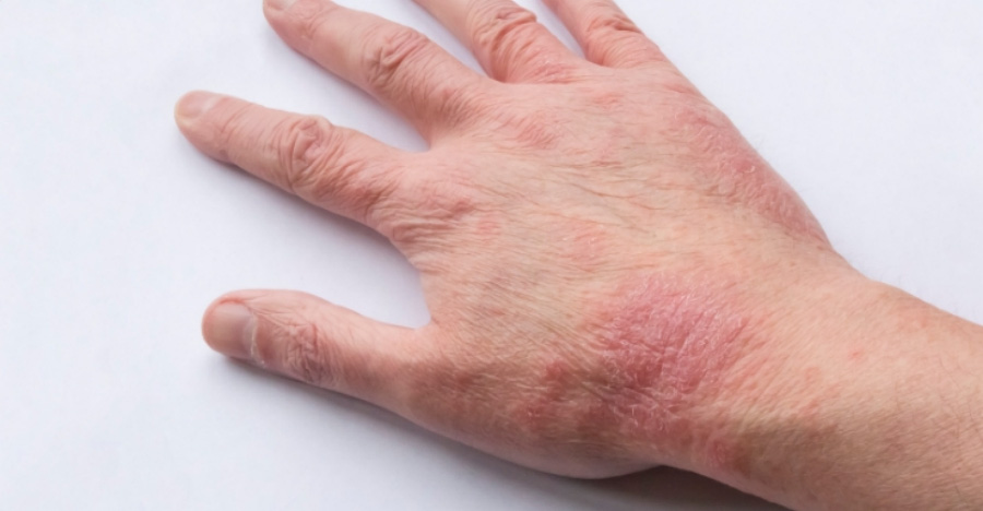 손목과 손등에 피부가 마르고 붉게 되는 아토피 증상이 있는 환자분이 하얀 바닥 위에 오른쪽 손을 올려두고 찍은 사진