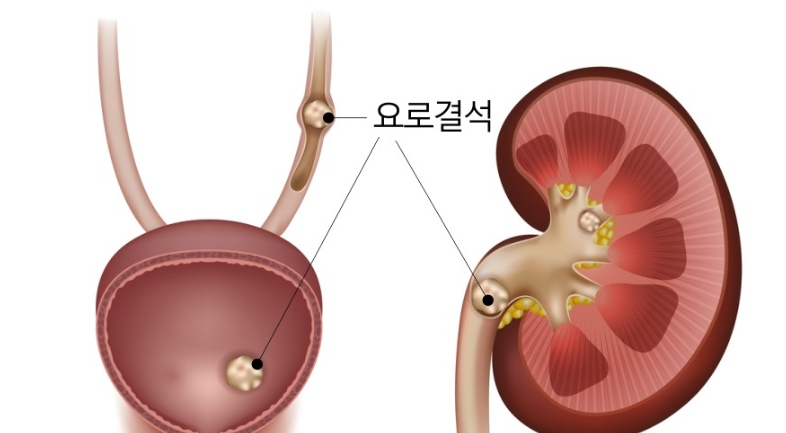 요로결석9