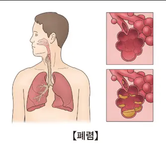 폐렴