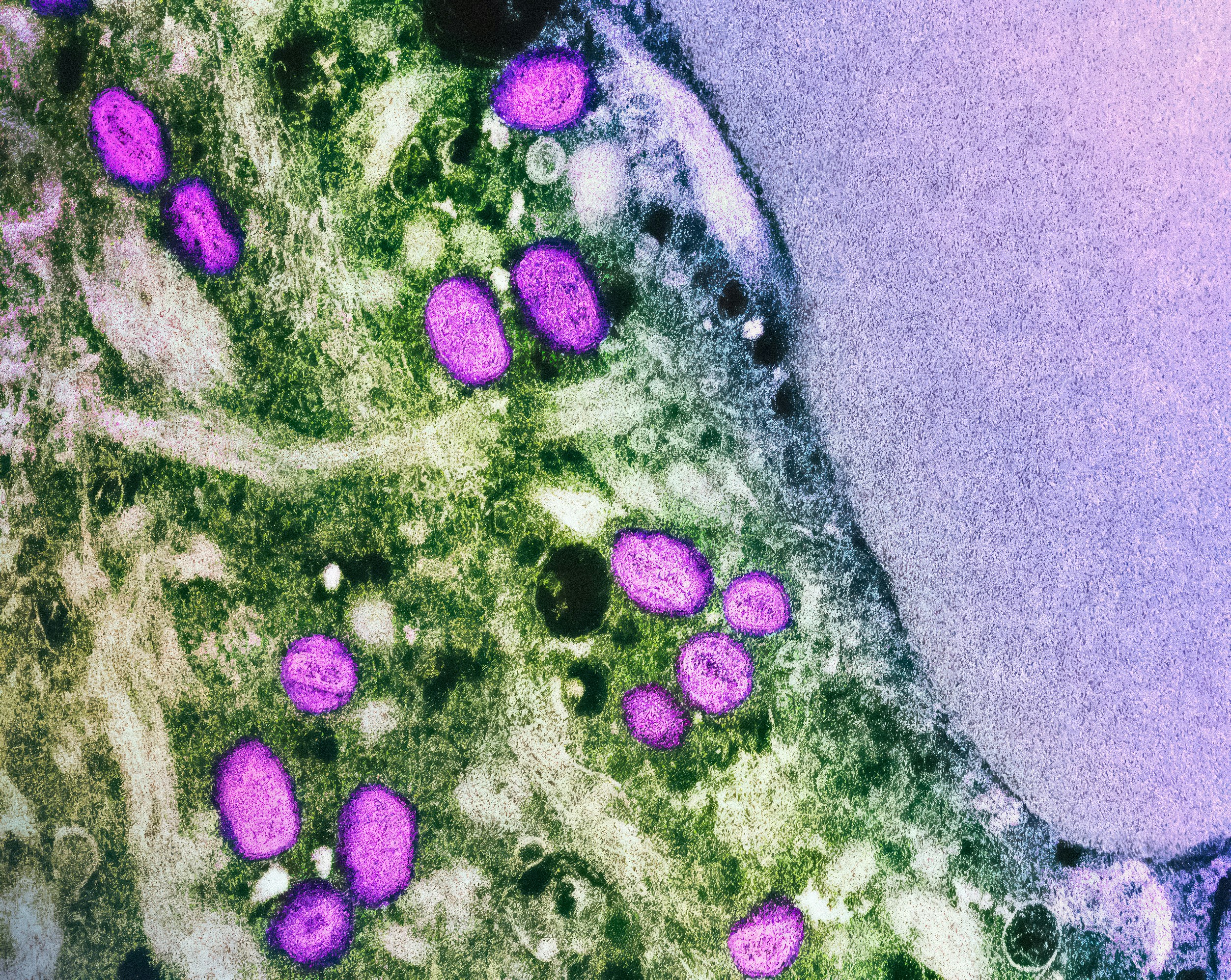 원숭이 두창 증상 및 감염경로 (+ 원인 백신 엠폭스)