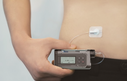 인슐린 펌프 이미지