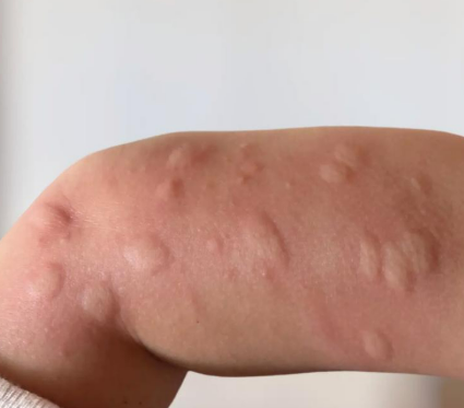 모기기피제 종류 및 효과 정리, 내가 잘 쓰는 벌레퇴치제는 전우 아쿠아가드 액