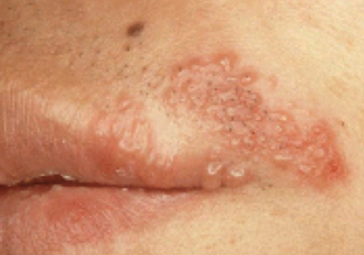 입술 주변 물집