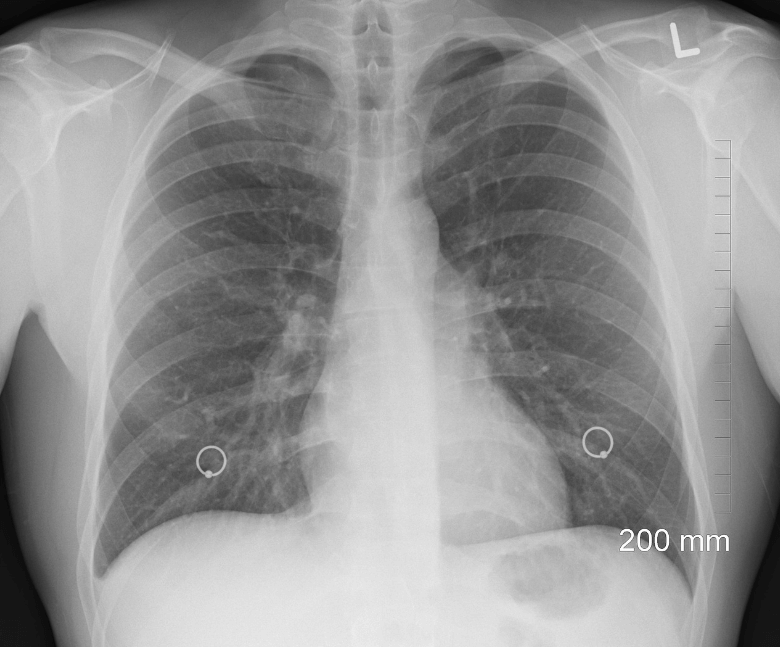 루닛-주가-전망-유상증자-무상증자-알아보기