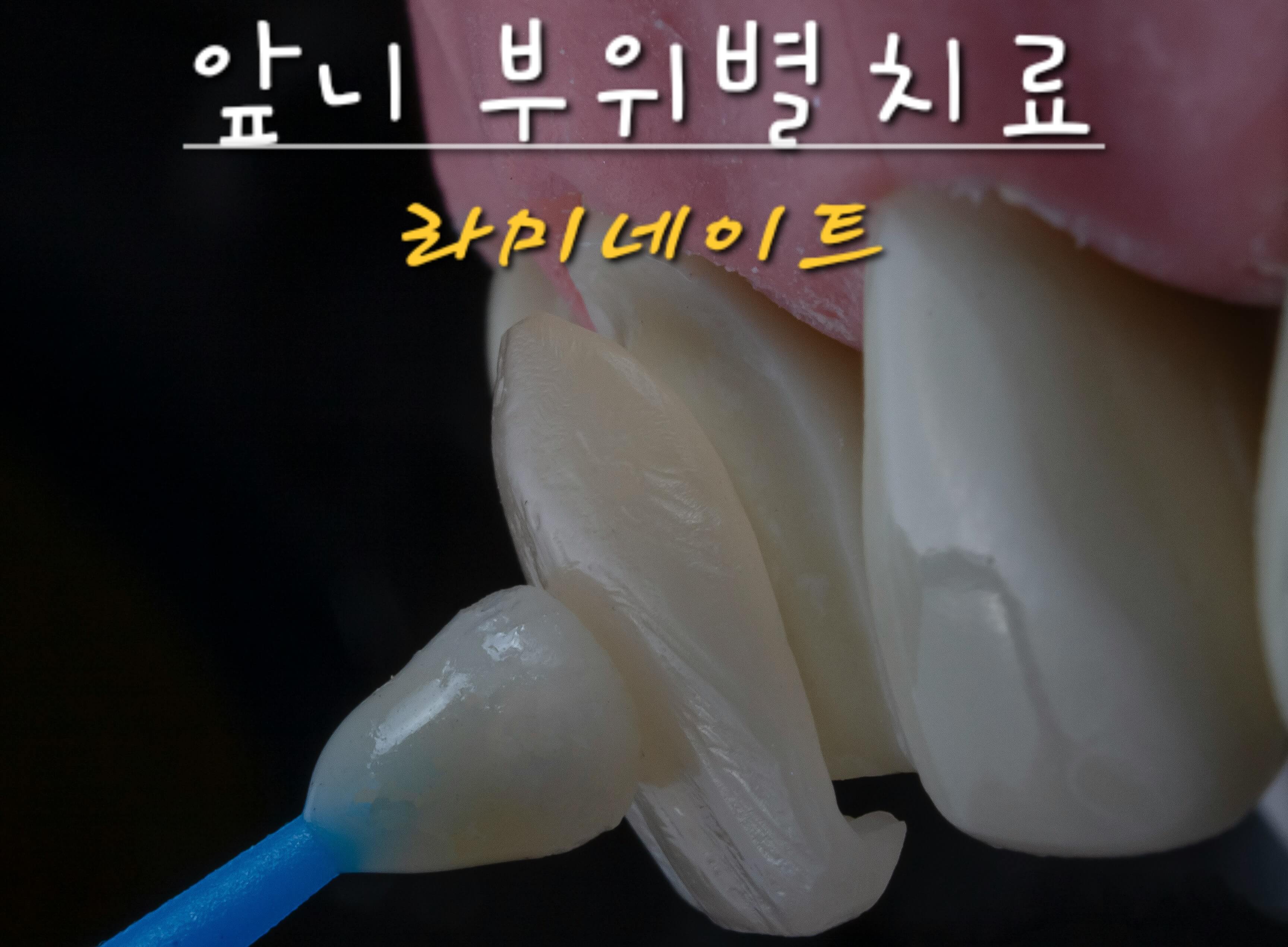 라미네이트사진