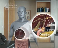 쓸개담석