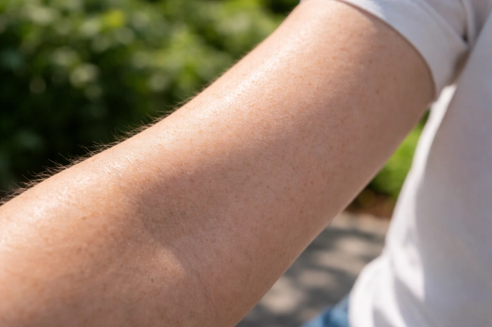 피부암 초기증상