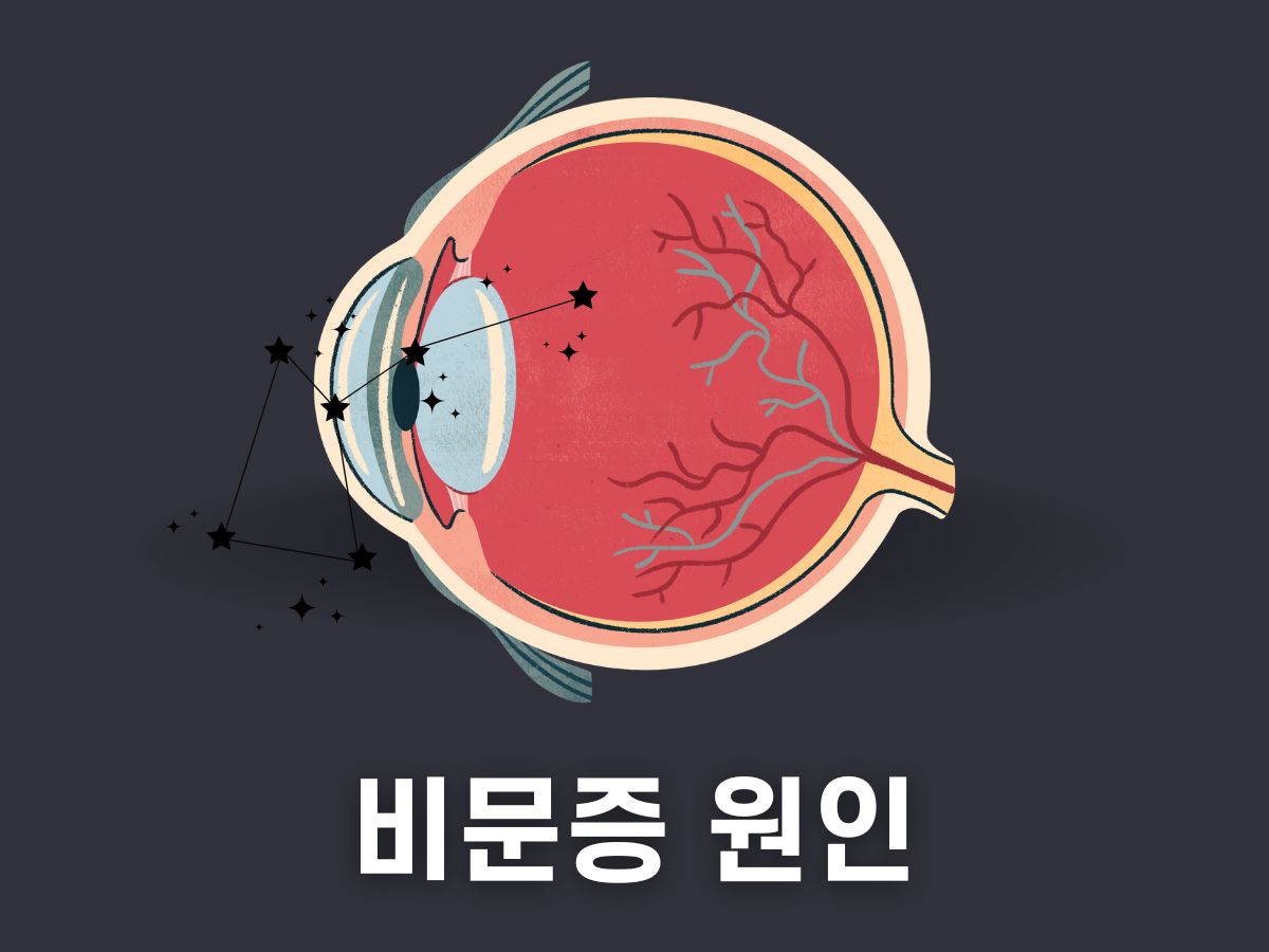 비문증 원인