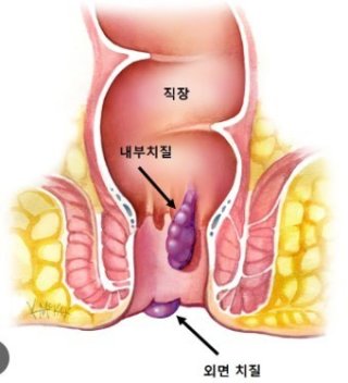 치질 수술
