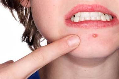 부위별 여드름 원인