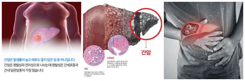 간암 설명 사진