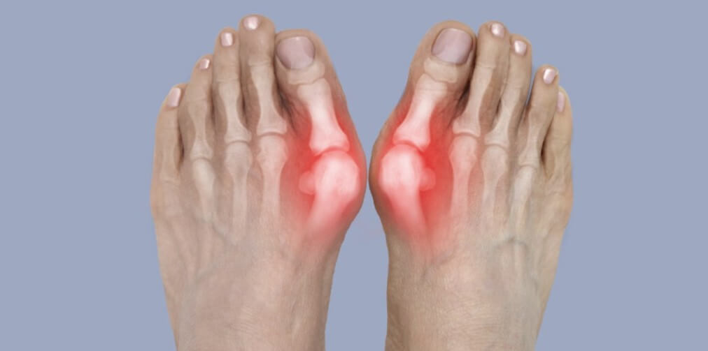 무지외반증 증상