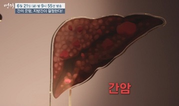 간암