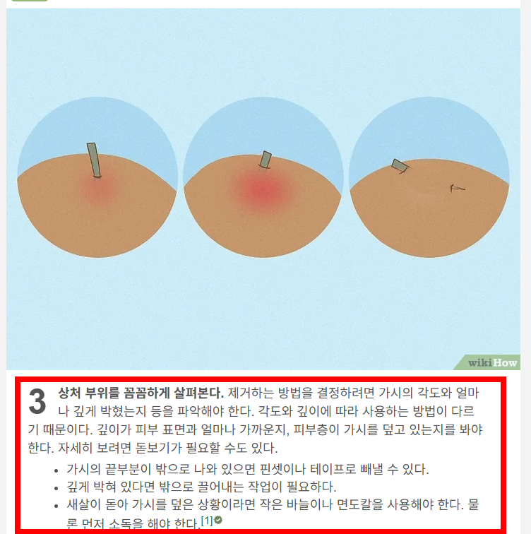 손가락 가시 빼는법 소개