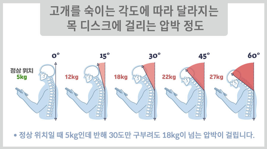 목 디스크에 걸리는 압박 정도