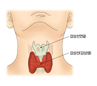갑상선암 출처 서울 아산병원 홈페이지