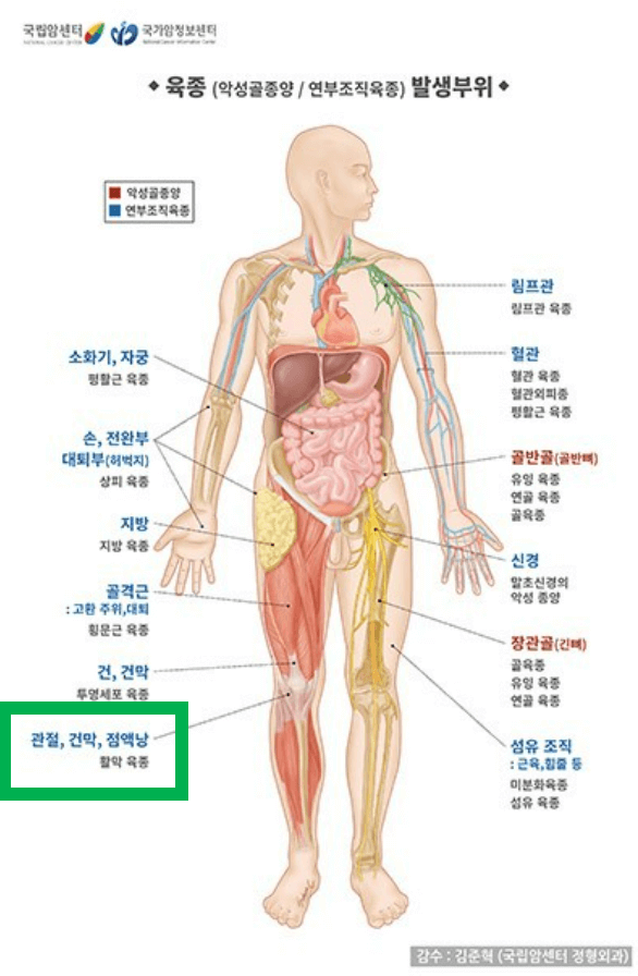 육종-발생부위