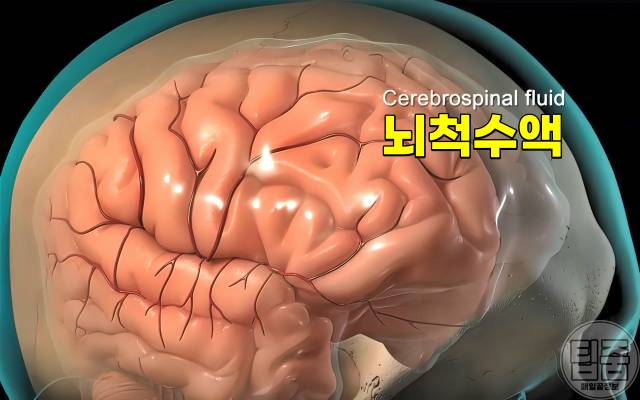 치매 증상 의심 정상압 뇌수두증