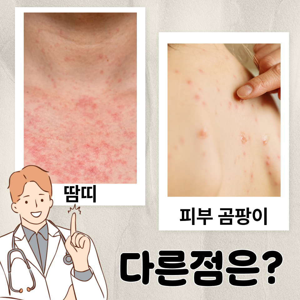 땀띠와 피부 곰팡이 감염에 대해서