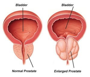 Eureka! The New Frontier of Benign Prostatic Hyperplasia Treatment - 'Urolift' Procedure.
