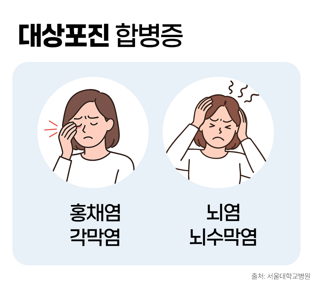 #대상포진 합병증 증상 #홍채염, 각막염, 뇌염, 뇌수막염