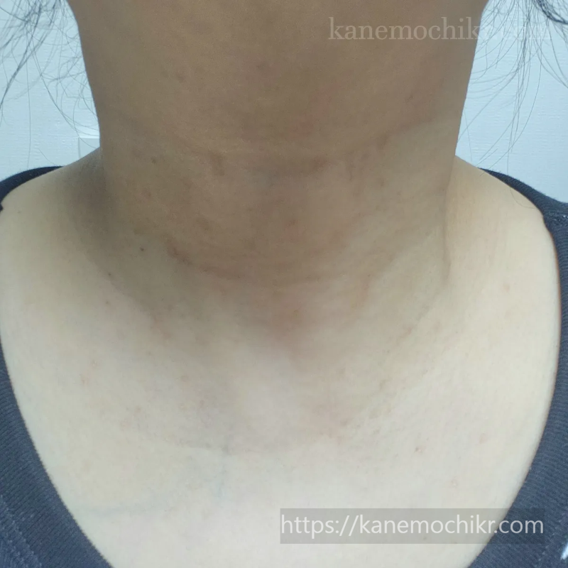 쥐젖-편평사마귀-제거11일차