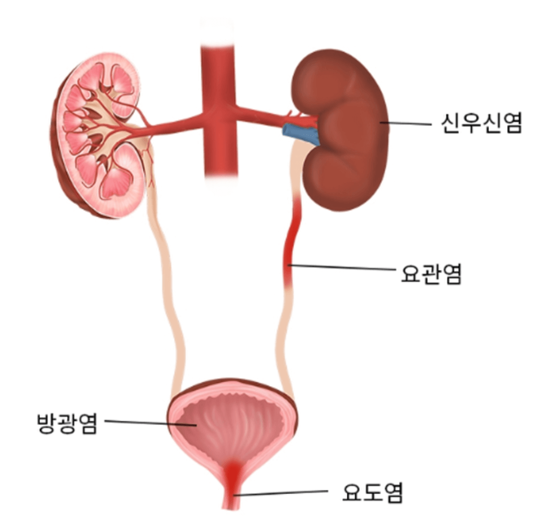 요로 감염