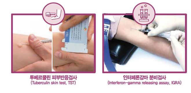 잠복결핵-검사