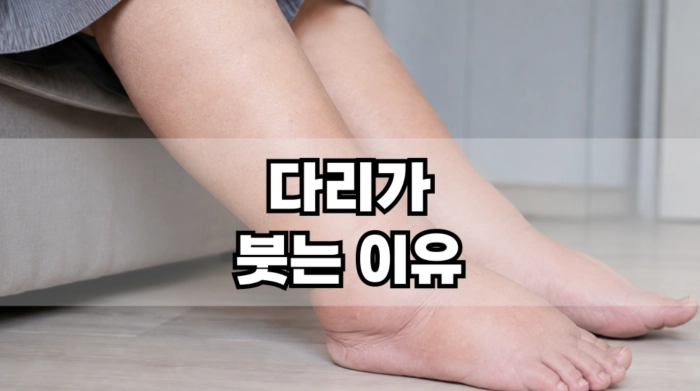 다리가 붓는 이유
