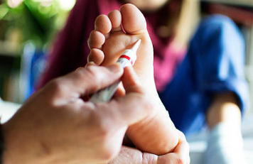 사마귀 제거방법 연고 추천 사마귀 냉동치료 원인 실비보험