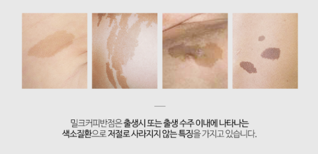 신경섬유종 밀크반점 원인 밀크커피점 카페오레점