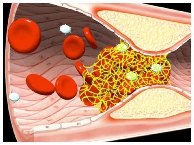 ldl 콜레스테롤 낮추는 방법