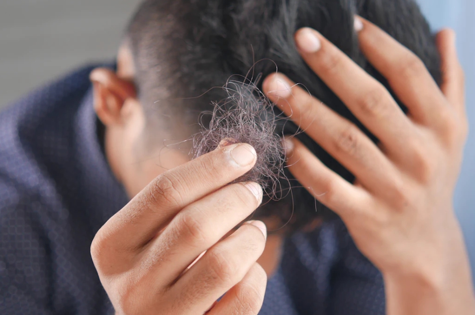 탈모