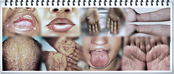 성병 매독(梅毒) Syphilis