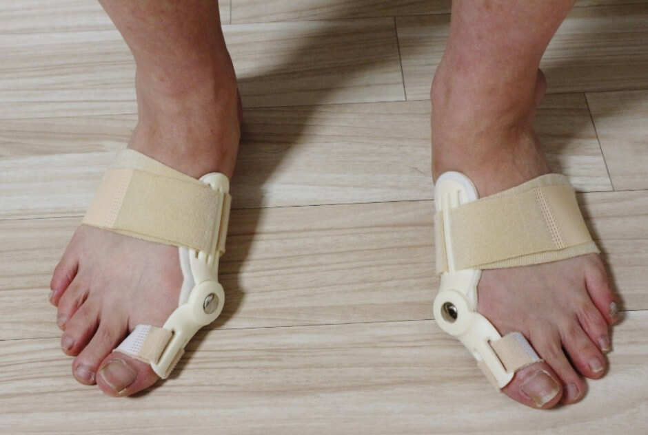 무지외반증 교정기 야간교정기