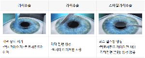 스마일라식