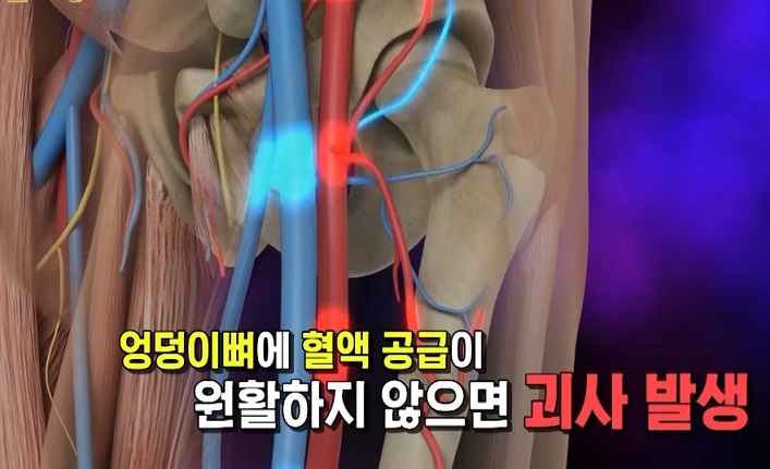 고관절-괴사