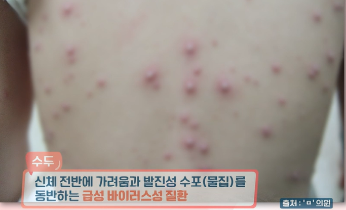 대상포진