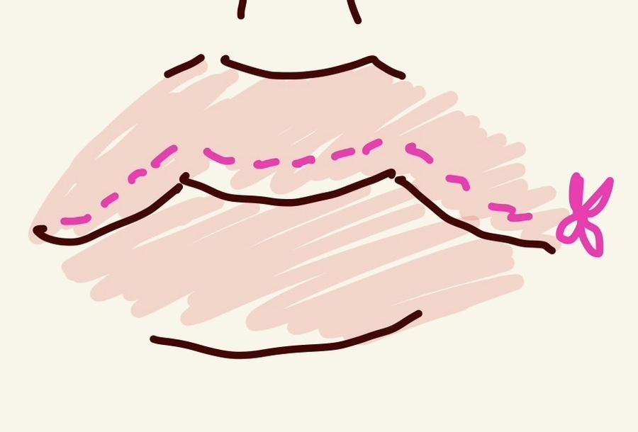 인중 축소 수술 후기