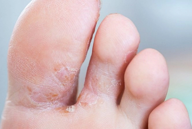 지간형 발무좀 (Interdigital type) 